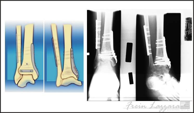 Mid-Range: Ankle illustration showing injury and surgical hardware per medical films